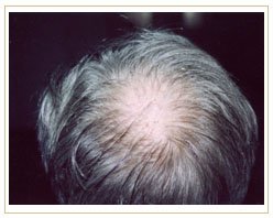 Slider image (3) ProHAIR Transplant Clinic